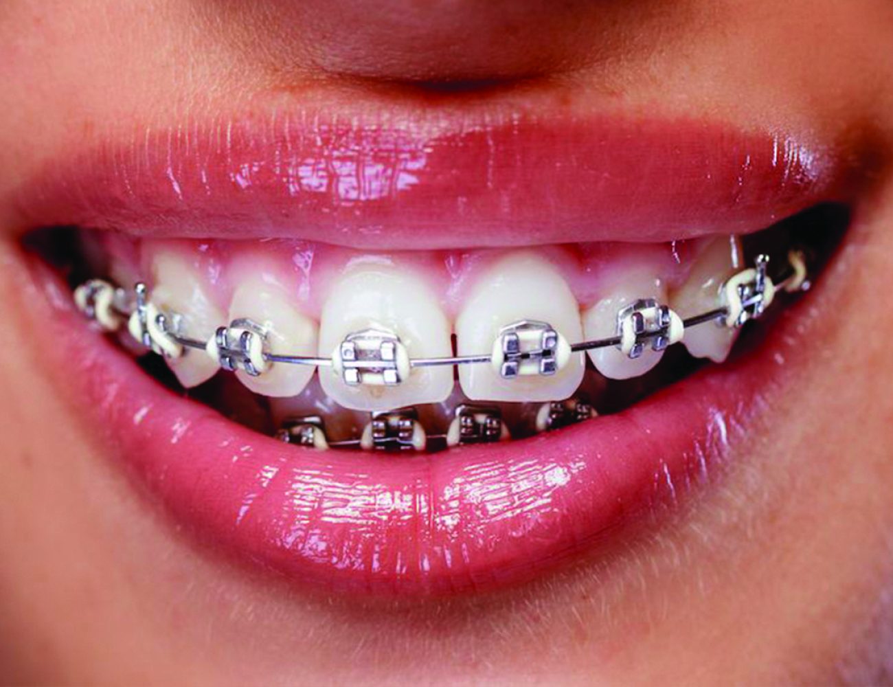 Fixed Braces